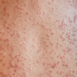 rash on the body